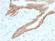 IHC testing of FFPE human pancreatic carcinoma with TROP2 antibody (clone TACSTD2/2153). Required HIER: boil tissue sections in pH 9 10mM Tris with 1mM EDTA for 10-20 min followed by cooling at RT for 20 min.