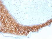 IHC testing of FFPE human basal cell carcinoma with TROP2 antibody (clone TACSTD2/2153). Required HIER: boil tissue sections in pH 9 10mM Tris with 1mM EDTA for 10-20 min followed by cooling at RT for 20 min.