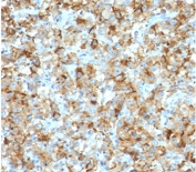IHC staining of FFPE human testicular carcinoma with StAR antibody (clone SARP1-1). Required HIER: boil tissue sections in pH 9 10mM Tris with 1mM EDTA for 10-20 min followed by cooling at RT for 20 min.