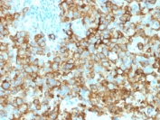 IHC testing of human melanoma with Melanoma gp100 antibody (clone PMEL/2039). Required HIER: boil tissue sections in 10mM citrate buffer, pH 6, for 10-20 min followed by cooling at RT for 20 min.