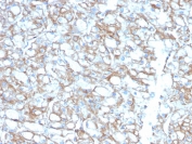 IHC testing of FFPE lung carcinoma with biotin-conjugated PD-L1 antibody (clone PDL1/2746). HIER: boil tissue sections in pH 9 10mM Tris with 1mM EDTA for 10-20 min followed by cooling at RT for 20 min.