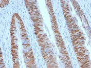 IHC testing of FFPE human colon carcinoma with recombinant CDX2 antibody (clone CDX2/2951R). HIER: boil tissue sections in 10mM Tris with 1mM EDTA, pH 9, for 10-20 min followed by cooling prior to testing.