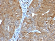 IHC testing of FFPE human prostate cancer with AKR1B1 antibody (clone ADRD1-1). Required HIER: boil tissue sections in 10mM citrate buffer, pH6, for 10-20 min followed by cooling at RT for 20 min.