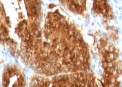 IHC testing of FFPE human prostate carcinoma with AMACR antibody (clone 2MACR-1). Required HIER: steam section in pH6 citrate buffer for 20 min and allow to cool prior to staining.