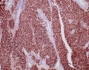 IHC staining of FFPE human urothelial carcinoma tissue with recombinant GATA Binding Protein 3 antibody (clone rGATA3/3870). HIER: boil tissue sections in pH 9 10mM Tris with 1mM EDTA for 20 min and allow to cool before testing.