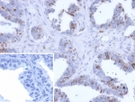 IHC staining of FFPE human prostate carcinoma tissue with BATF2 antibody (clone PCRP-BATF2-2B9). Inset: PBS used in place of primary Ab (secondary Ab negative control). HIER: boil tissue sections in pH 9 10mM Tris with 1mM EDTA for 20 min and allow to cool before testing.
