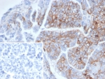 IHC staining of FFPE human ovarian cancer tissue with CD56 antibody (clone NCAM1/6715). Inset: PBS used in place of primary Ab (secondary Ab negative control). HIER: boil tissue sections in pH 9 10mM Tris with 1mM EDTA for 20 min and allow to cool before testing.