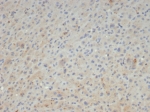 IHC staining of FFPE human hepatocellular carcinoma tissue with A2M antibody (clone A2M/4847). HIER: boil tissue sections in pH 9 10mM Tris with 1mM EDTA for 20 min and allow to cool before testing.