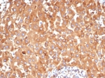 IHC staining of FFPE human hepatocellular carcinoma tissue with Alpha-2-Macroglobulin antibody (clone A2M/6554). HIER: boil tissue sections in pH 9 10mM Tris with 1mM EDTA for 20 min and allow to cool before testing.