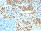 IHC staining of FFPE human ovarian carcinoma tissue with Cytokeratin-7 antibody (clone KRT7/3733). Inset: PBS used in place of primary Ab (secondary Ab negative control). HIER: boil tissue sections in pH 9 10mM Tris with 1mM EDTA for 20 min and allow to cool before testing.