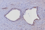 IHC staining of FFPE human prostate tissue with Cytokeratin 6 antibody (clone KRT6/8198R). HIER: boil tissue sections in pH 9 10mM Tris with 1mM EDTA for 20 min and allow to cool before testing.