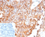 IHC staining of FFPE human ovarian carcinoma tissue with SERPINA1 antibodyAlpha-1-Antitrypsin antibody (clone AAT/6323). Inset: PBS used in place of primary Ab (secondary Ab negative control). HIER: boil tissue sections in pH 9 10mM Tris with 1mM EDTA for 20 min and allow to cool before testing.