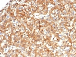 IHC staining of FFPE human kidney carcinoma tissue with Alpha-1-Antitrypsin antibody (clone AAT/4609). HIER: boil tissue sections in pH 9 10mM Tris with 1mM EDTA for 20 min and allow to cool before testing.