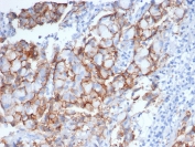 IHC staining of FFPE human breast carcinoma tissue stained with ErbB2 antibody (clone ERBB2/6637) at 2ug/ml. HIER: boil tissue sections in pH 9 10mM Tris with 1mM EDTA for 20 min and allow to cool before testing.