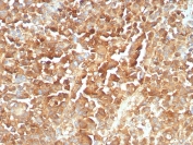 IHC staining of FFPE human melanoma tissue with recombinant NGFR antibody (clone rNGFR/8824). HIER: boil tissue sections in pH 9 10mM Tris with 1mM EDTA for 20 min and allow to cool before testing.