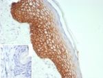 IHC staining of FFPE human skin tissue with DSG3 antibody (clone rDSG3/8612). Inset: PBS used in place of primary Ab (secondary Ab negative control). HIER: boil tissue sections in pH 9 10mM Tris with 1mM EDTA for 20 min and allow to cool before testing.