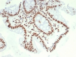IHC staining of FFPE human colon carcinoma tissue with Hepatoma Derived Growth Factor antibody (clone PCRP-HDGF-1D1). HIER: boil tissue sections in pH 9 10mM Tris with 1mM EDTA for 20 min and allow to cool before testing.