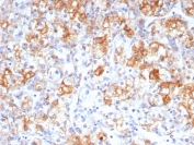 IHC staining of FFPE human renal cell carcinoma tissue with COX2 antibody (clone rCOX2/6996). HIER: boil tissue sections in pH 9 10mM Tris with 1mM EDTA for 20 min and allow to cool before testing.