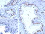 IHC staining of FFPE human prostate tissue with Solute carrier family 45 member 3 antibody (clone SLC45A3/7649). Inset: PBS used in place of primary Ab (secondary Ab negative control). HIER: boil tissue sections in pH 9 10mM Tris with 1mM EDTA for 20 min and allow to cool before testing.