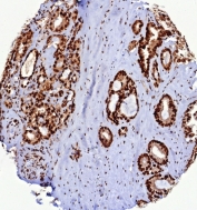 IHC staining of FFPE human prostate carcinoma tissue with PCNA antibody (clone PCNA/8633R). HIER: boil tissue sections in pH 9 10mM Tris with 1mM EDTA for 20 min and allow to cool before testing.