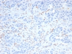 IHC staining of FFPE human kidney cancer with Sal-like 4 antibody (clone SALL4/7802R). HIER: boil tissue sections in pH 9 10mM Tris with 1mM EDTA for 20 min and allow to cool before testing.