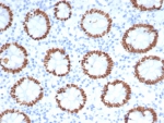 IHC staining of FFPE human colon tissue with SATB2 antibody. Strong nuclear staining is observed using clone SATB2/7112 at 2ug/ml. Inset: PBS used in place of primary Ab (secondary Ab negative control). HIER: boil tissue sections in pH 9 10mM Tris with 1mM EDTA for 20 min and allow to cool before testing.