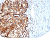 IHC staining of FFPE human kidney cancer tissue with CD26 antibody (clone DPP4/7415). HIER: boil tissue sections in pH 9 10mM Tris with 1mM EDTA for 20 min and allow to cool before testing.