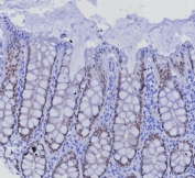 IHC staining of FFPE human colon carcinoma tissue with SATB2 antibody (clone SATB2/7488) at 2ug/ml. Inset: PBS used in place of primary Ab (secondary Ab negative control). HIER: boil tissue sections in pH 9 10mM Tris with 1mM EDTA for 20 min and allow to cool before testing.