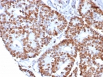 IHC staining of FFPE human colon cancer tissue with Nucleolin antibody (clone NCL/8068R). HIER: boil tissue sections in pH 9 10mM Tris with 1mM EDTA for 20 min and allow to cool before testing.