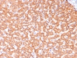 IHC staining of FFPE human hepatocellular carcinoma tissue with ADH1L1 antibody (clone ALDH1L1/7969). HIER: boil tissue sections in pH 9 10mM Tris with 1mM EDTA for 20 min and allow to cool before testing.