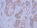 IHC staining of FFPE human lung carcinoma tissue with ROS1 antibody (clone ROS1/7999R). HIER: boil tissue sections in pH 9 10mM Tris with 1mM EDTA for 20 min and allow to cool before testing.