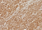 IHC staining of FFPE human colon carcinoma tissue with PMS2 antibody (clone PMS2/8374R). HIER: boil tissue sections in pH 9 10mM Tris with 1mM EDTA for 20 min and allow to cool before testing.