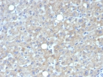 IHC staining of FFPE human hepatocellular carcinoma tissue with Glypican-3 antibody (clone GPC3/7419). HIER: boil tissue sections in pH 9 10mM Tris with 1mM EDTA for 20 min and allow to cool before testing.