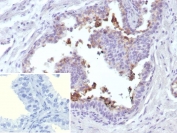 IHC staining of FFPE human prostate cancer tissue with ABCC4 antibody (clone ABCC4/9018). Inset: PBS used in place of primary Ab (secondary Ab negative control).