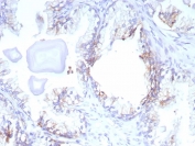 IHC staining of FFPE human prostate cancer tissue with MRP4 antibody (clone ABCC4/9179). HIER: boil tissue sections in pH 9 10mM Tris with 1mM EDTA for 20 min and allow to cool before testing.