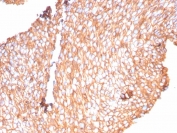 IHC staining of FFPE human bladder carcinoma tissue with recombinant Uroplakin 1B antibody (clone UPK1B/9258R). HIER: boil tissue sections in pH 9 10mM Tris with 1mM EDTA for 20 min and allow to cool before testing.