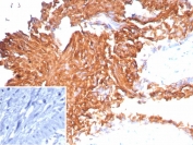 IHC staining of FFPE human bladder carcinoma tissue with recombinant Uroplakin 1B antibody (clone UPK1B/9258R). Inset: PBS used in place of primary Ab (secondary Ab negative control). HIER: boil tissue sections in pH 9 10mM Tris with 1mM EDTA for 20 min and allow to cool before testing.