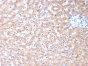 IHC staining of FFPE human hepatocellular carcinoma tissue with ADH1L1 antibody (clone ALDH1L1/7959). HIER: boil tissue sections in pH 9 10mM Tris with 1mM EDTA for 20 min and allow to cool before testing.