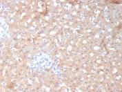 IHC staining of FFPE human hepatocellular carcinoma tissue with ADH1L1 antibody (clone ALDH1L1/7970). HIER: boil tissue sections in pH 9 10mM Tris with 1mM EDTA for 20 min and allow to cool before testing.