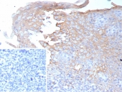 IHC staining of FFPE human tonsil tissue with Interferon gamma antibody (clone IFNG/9012). Inset: PBS used in place of primary Ab (secondary Ab negative control). HIER: boil tissue sections in pH 9 10mM Tris with 1mM EDTA for 20 min and allow to cool before testing.