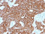 IHC staining of FFPE human colon tissue with recombinant CK8/18 antibody (KRT8.18/6579R). HIER: boil tissue sections in pH 9 10mM Tris with 1mM EDTA for 20 min and allow to cool before testing.