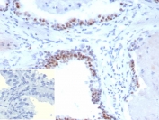 IHC staining of FFPE human prostate carcinoma tissue with recombinant Androgen Receptor V7 antibody (clone DHTR.V7/9394R). HIER: boil tissue sections in pH 9 10mM Tris with 1mM EDTA for 20 min and allow to cool before testing.
