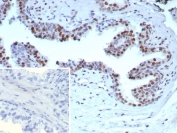 IHC staining of FFPE human prostate carcinoma tissue with recombinant AR-V7 antibody (clone DHTR/9119R). Inset: PBS used in place of primary Ab (secondary Ab negative control). HIER: boil tissue sections in pH 9 10mM Tris with 1mM EDTA for 20 min and allow to cool before testing.