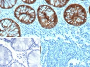 IHC staining of FFPE human colon tissue with recombinant E-Cadherin antibody (clone rCDH1/9615). Inset: PBS used in place of primary Ab (secondary Ab negative control). HIER: boil tissue sections in pH 9 10mM Tris with 1mM EDTA for 20 min and allow to cool before testing.