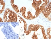 IHC staining of FFPE human prostate carcinoma tissue with KRT5/6 antibody (clone KRT5.6/9104). Inset: PBS used in place of primary Ab (secondary Ab negative control). HIER: boil tissue sections in pH 9 10mM Tris with 1mM EDTA for 20 min and allow to cool before testing.