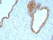 IHC staining of FFPE human prostate carcinoma tissue with CK5/6 antibody (clone KRT5.6/9104). HIER: boil tissue sections in pH 9 10mM Tris with 1mM EDTA for 20 min and allow to cool before testing.