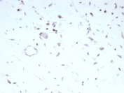 IHC staining of FFPE human rhabdomyosarcoma tissue with recombinant Myoblast determination protein 1 antibody (clone MYOD1/9405R). HIER: boil tissue sections in pH 9 10mM Tris with 1mM EDTA for 20 min and allow to cool before testing.
