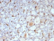 IHC staining of FFPE human thyroid tissue with recombinant TSH Receptor antibody (clone TSHRB/1607R). HIER: boil tissue sections in pH 9 10mM Tris with 1mM EDTA for 20 min and allow to cool before testing.