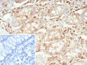 IHC staining of FFPE human colon carcinoma tissue with recombinant STMN1 antibody (clone rSTMN1/9255). Inset: PBS used in place of primary Ab (secondary Ab negative control). HIER: boil tissue sections in pH 9 10mM Tris with 1mM EDTA for 20 min and allow to cool before testing.