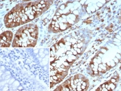IHC staining of FFPE human colon carcinoma tissue with Stathmin 1 antibody (clone STMN1/8437). Inset: PBS used in place of primary Ab (secondary Ab negative control). HIER: boil tissue sections in pH 9 10mM Tris with 1mM EDTA for 20 min and allow to cool before testing.